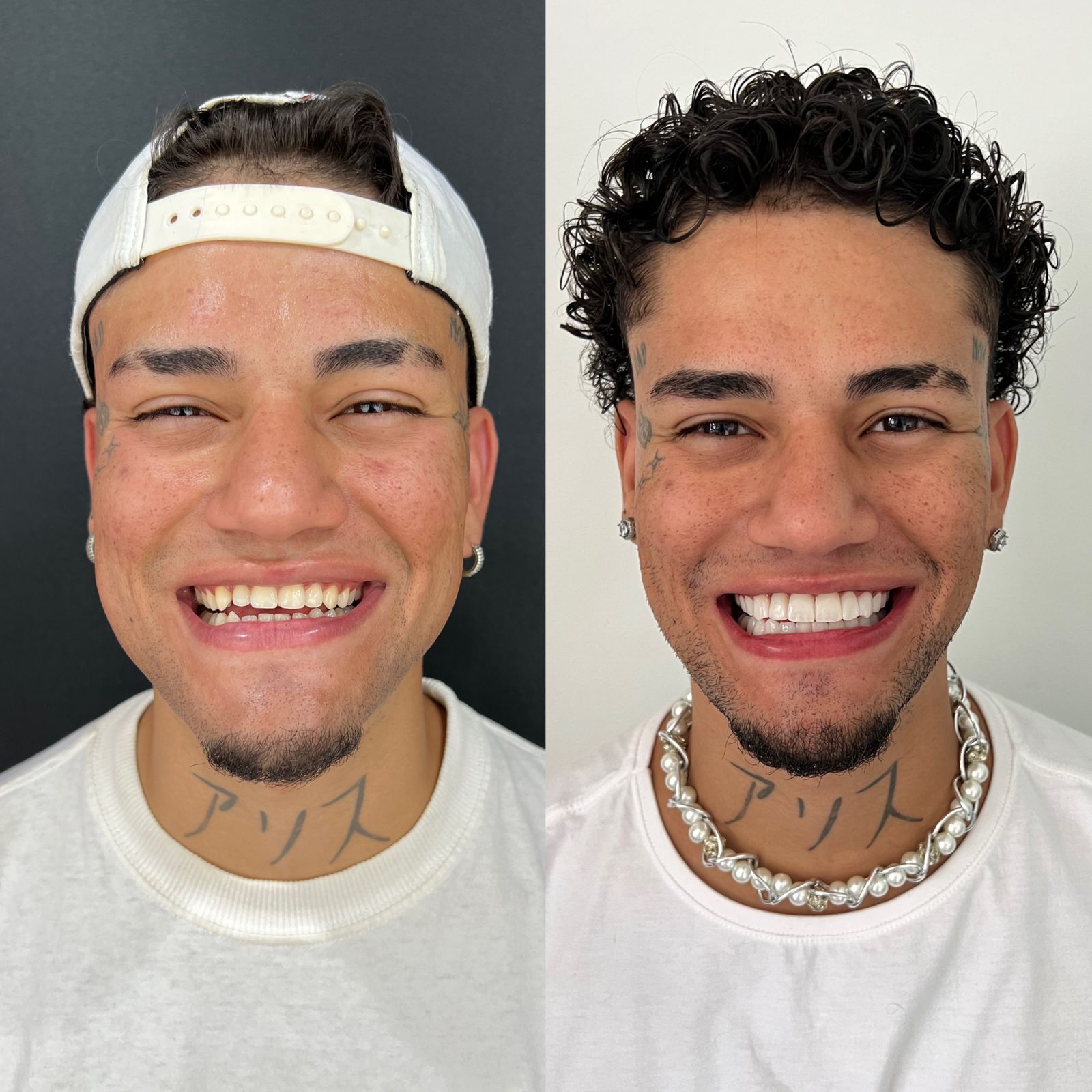 Sorridentes-Antes-e-depois-resinas-1