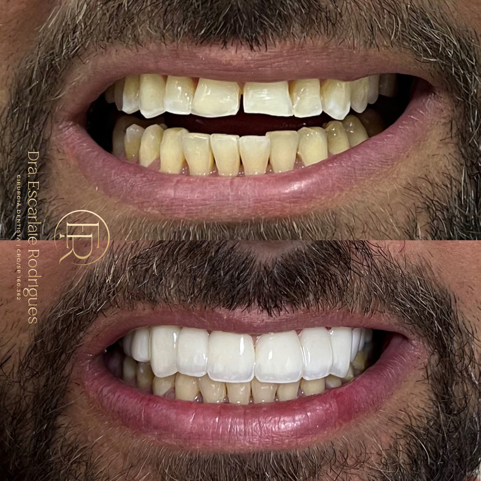 Sorridentes-Antes-e-depois-resinas-2