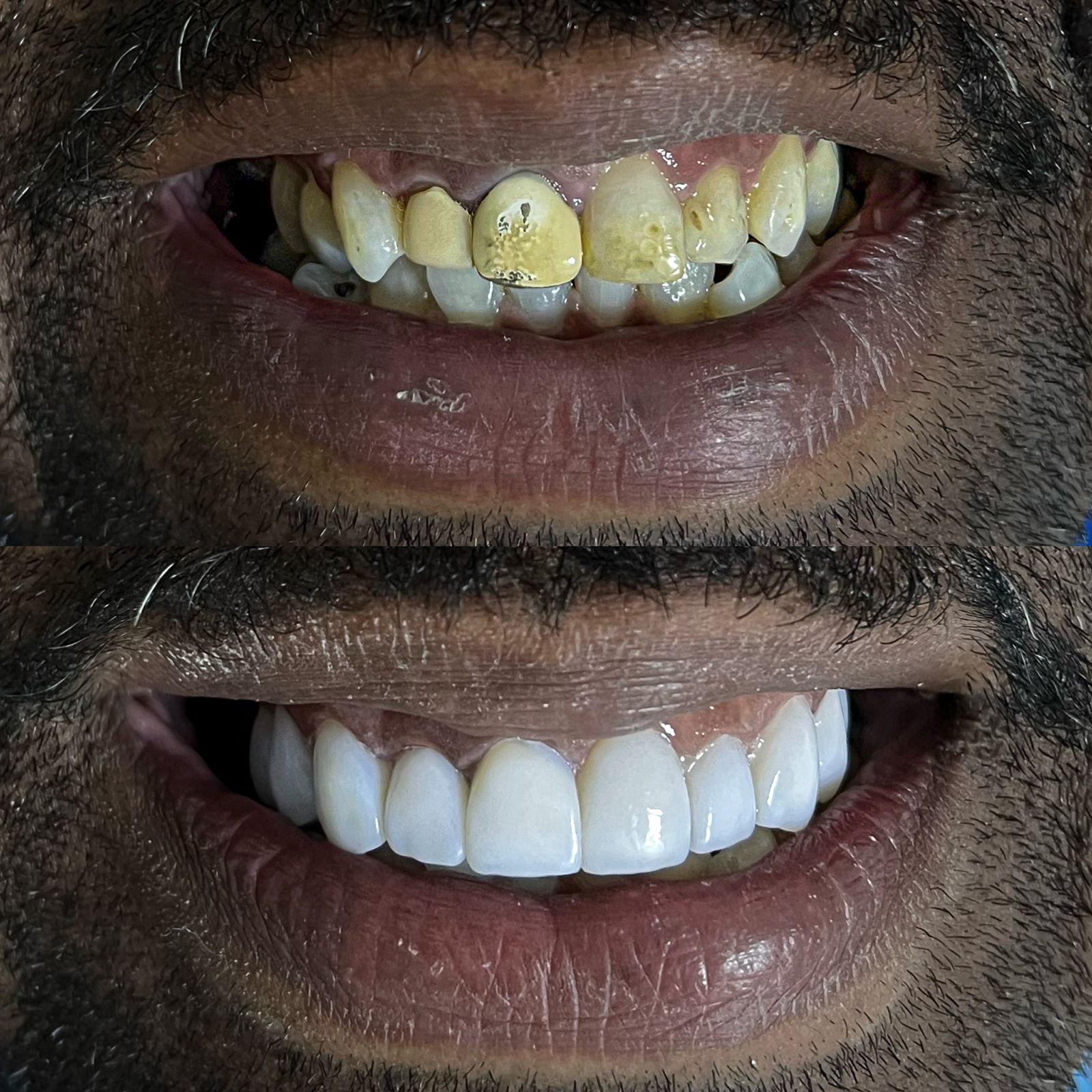 Sorridentes-Antes-e-depois-resinas-3