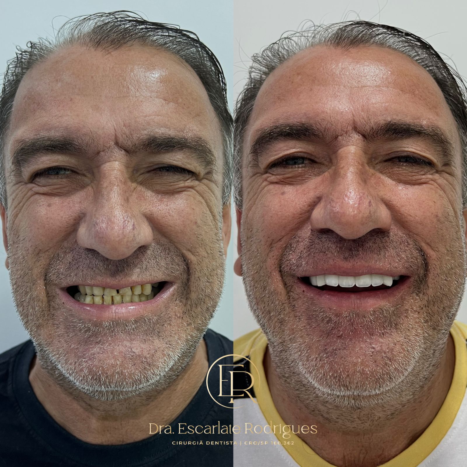 Sorridentes-Antes-e-depois-resinas-4