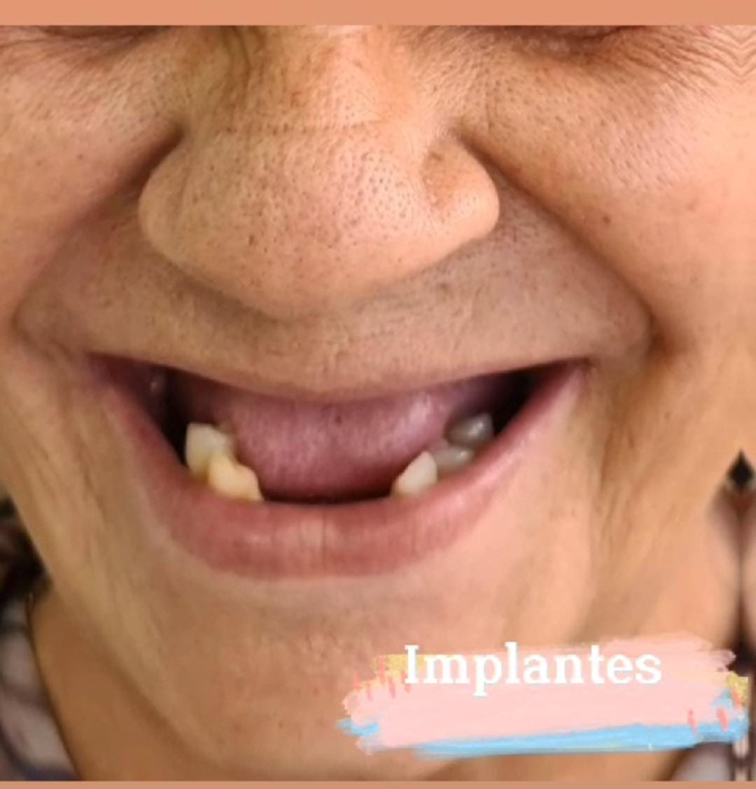 Implante-Antes-01