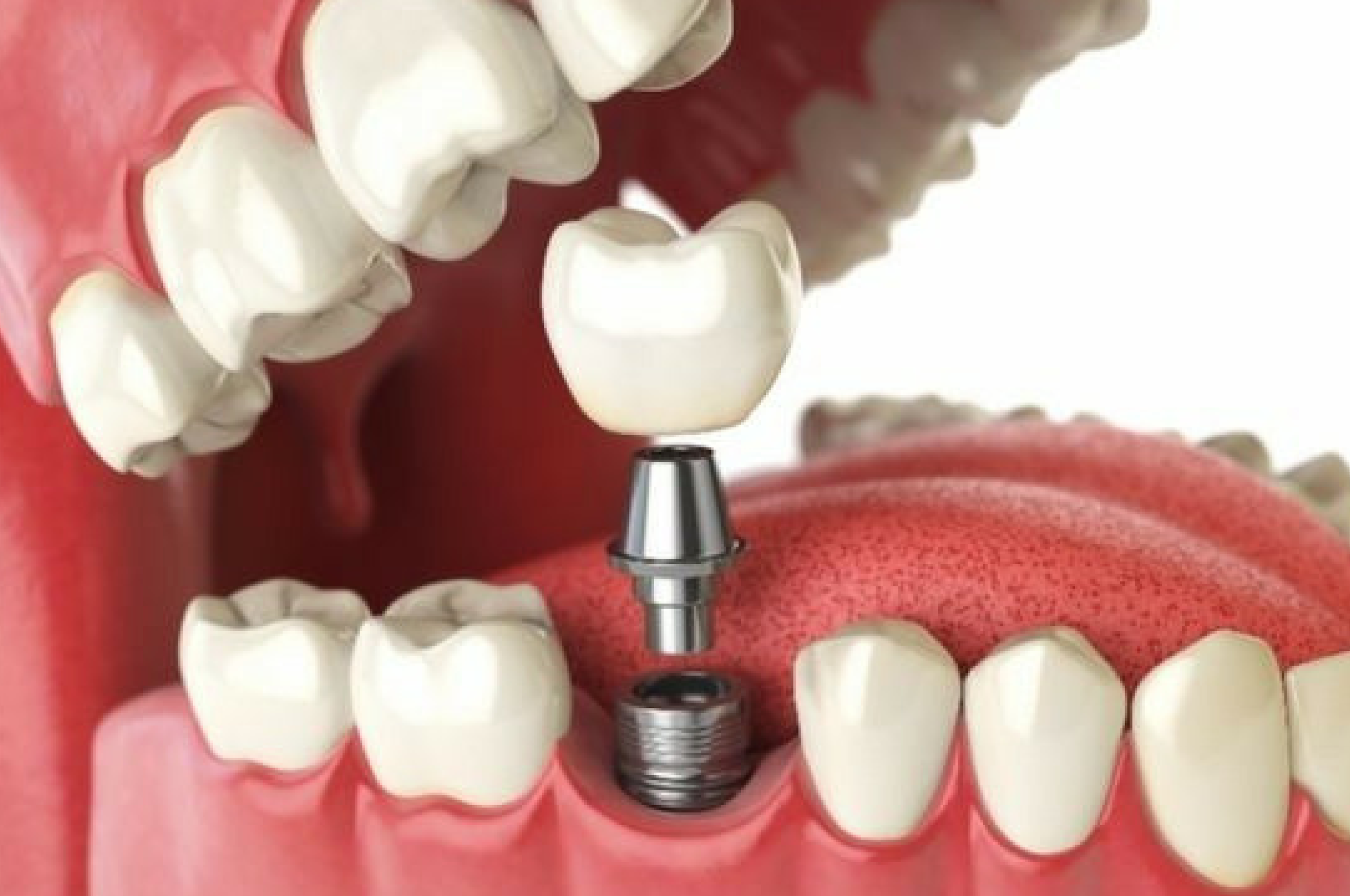 implante-dental-unitario