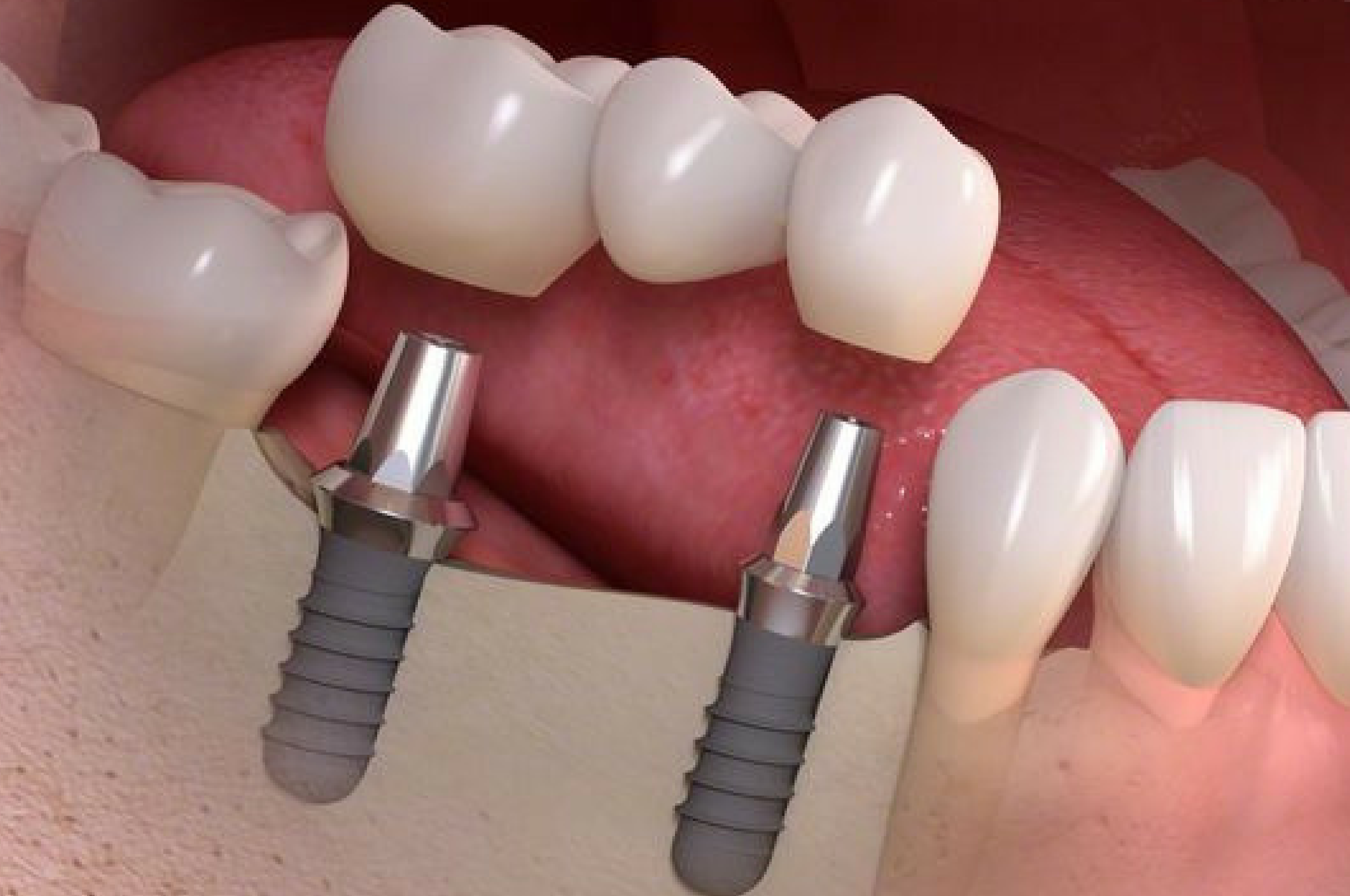 implantes-para-protesis-fija