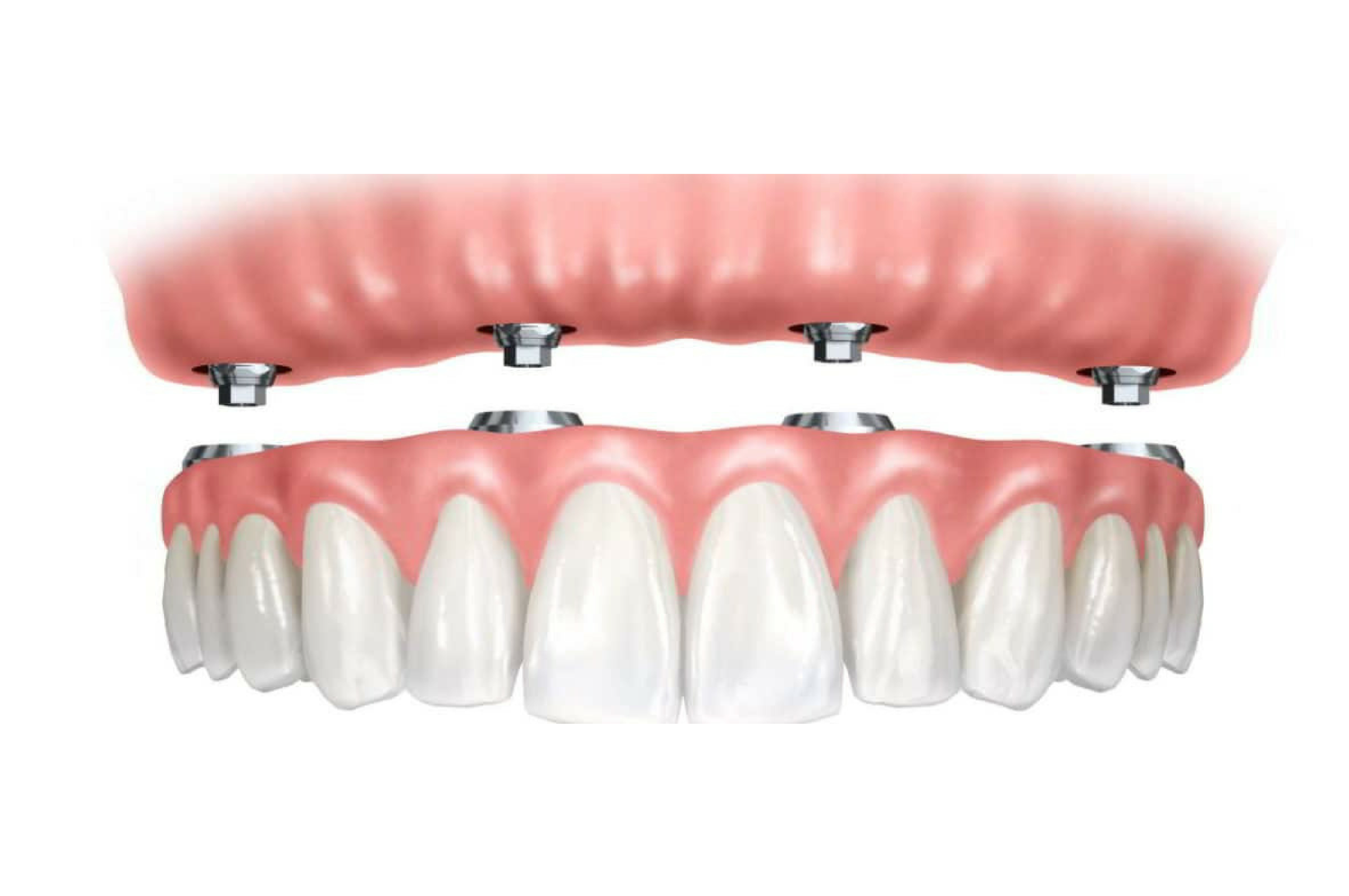 implantes-para-protesis-total-semifija